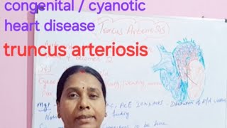 congenitalcyanotic heart disease truncus arteriosis [upl. by Ahsitak133]