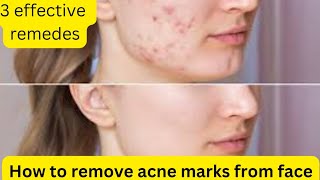 HOW TO REMOVE ACNE MARKS FROM FACE  3 EASY AND EFFECTIVE REMEDIES [upl. by Aracahs849]