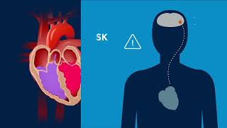 Atrial fibrillation symptoms [upl. by Annabelle80]