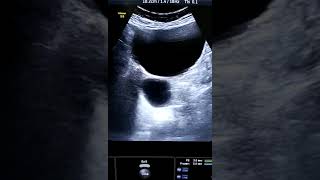 Adnexal hemorrhagic cyst videos ultrasound viral viral video [upl. by Pacian125]