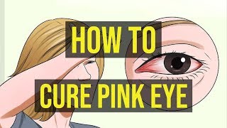 How To Cure Pink Eye Fast  5 Quick Ways [upl. by Fachan]