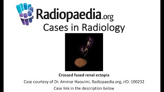 Crossed fused renal ectopia Radiopaediaorg Cases in Radiology [upl. by Eelhsa]