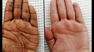 How to Get Soft Wrinkle Free Hands  Homemade Recipe For Dry Rough Hands amp Feet [upl. by Anihcak]