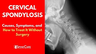 CERVICAL SPONDYLOSIS Causes Symptoms and Treatment NO SURGERY [upl. by Lemieux119]