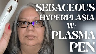 Successful Sebaceous Hyperplasia removal athome  Customer Testimonial  Snow Skin Co [upl. by Ahseid]