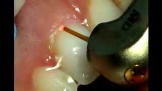 Waterlase MD Gingivectomy [upl. by Sanborn]