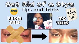 How to get rid of a styecold sore overnight [upl. by Aissela]