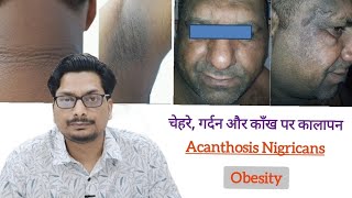 चेहरे गर्दन और काँख की skin का कालापन Face amp Neck pigmentation removal cream amp treatment Acanthosis [upl. by Ytirahs]