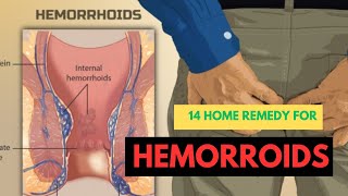 14 HOME REMEDIES FOR HEMORRHOIDS [upl. by Alleul]