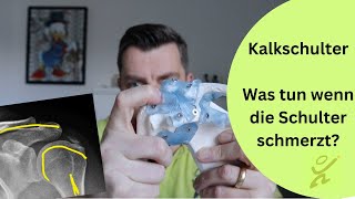 Kalkschulter  Was tun wenn sie Schulter schmerzt [upl. by O'Neill]