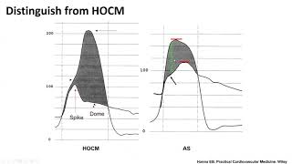 Hemodynamic assessment of aortic stenosis technical tips Elias Hanna Univ of Iowa [upl. by Naujej143]