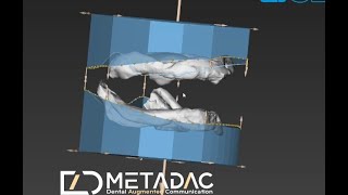 Digital Dentures Edentulous models [upl. by Occor]