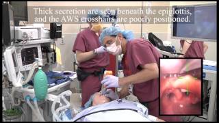 Combined Pentax AWS and Fiberscope Intubation from AOD rerelease [upl. by Kersten]