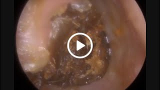 954  Colossal Aural Polyp Ear Wax Removal [upl. by Trumann300]