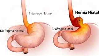 ¿Qué es y cómo se trata una hernia hiatal [upl. by Anyahs223]