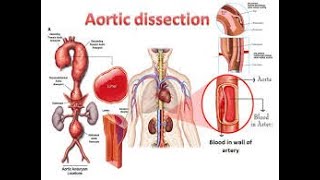 AORTIC DISSECTION  Stanford classification  Debakey classification  symptoms and management [upl. by Tsan447]