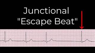 8 Junctional rhythms [upl. by Rosemare]