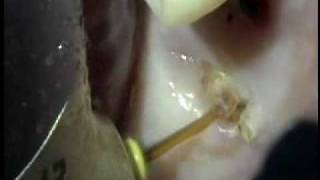 Tooth Extraction 1 with Waterlase [upl. by O'Brien]