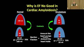 ATTR Cardiac Amyloidosis Treating the Symptoms [upl. by Dalila]