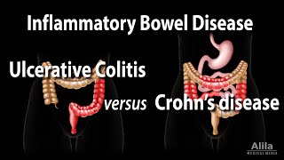 Ulcerative Colitis versus Crohns Disease Animation [upl. by Eneles]