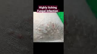 Highly Itching Fungal Infection  Ringworm of Groin  Tinea cruris [upl. by Vickie524]