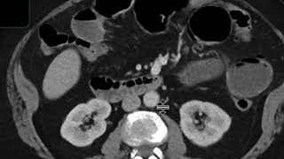 Gallstone ileus [upl. by Dori]