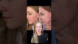 Julia Nitchmans results using the Ole Henriksen Glow Cycle routine [upl. by Assadah]