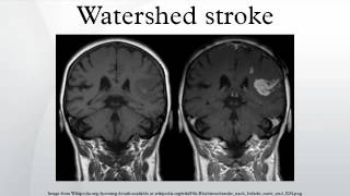 Watershed stroke [upl. by Oramlub]