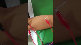 Tennis Elbow Pain Treatment by Acupuncture needles tens [upl. by Zorina]