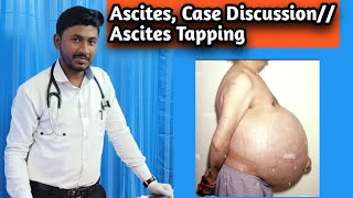 Ascites  Case Discussion Ascites Tapping Procedure [upl. by Sansen]