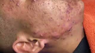 Loan Nguyen Acne Treatment 11399 [upl. by Aanas101]