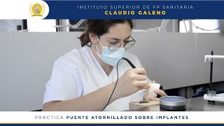 Puente atornillado sobre implantes  Prótesis Dentales [upl. by Etheline]