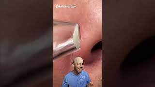 I wouldn’t recommend a pore vacuum 🛑 credit zudaifuarturo on TT doctor satisfying viral [upl. by Krauss]