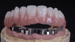 All on 4 implant bar supported denture [upl. by Aer]