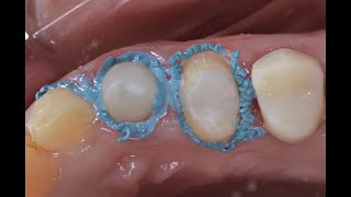 Gingival troughing by electrosurgery [upl. by Cantu79]