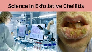 Exploring the Science of Exfoliative Cheilitis Unraveling the Mysteries [upl. by Anircam]