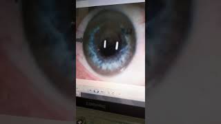 ترسب النحاس داء ويلسونspot diagnosis [upl. by Strickland]