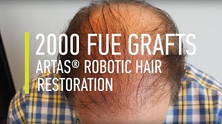 Hair transplant 2000 FUE Grafts ARTAS® Robotic Hair Restoration  Hair By Dr Max [upl. by Helli137]