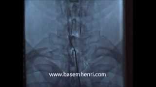 تسليك إلتصاقات القناة العصبية العنقية لعلاج الجراحات السابقة الفاشلة د باسم هنرى CX neuroplasty [upl. by Jodi869]