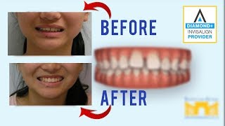 Invisalign Before and After Gap in Teeth [upl. by Lynus]