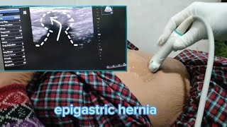 epigastric hernia usg [upl. by Anirdnaxela250]