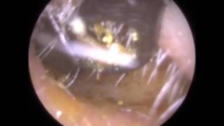 191 BEATING Eardrum visible after simple Ear Wax Removal  Mr Neel Raithatha The Hear Clinic [upl. by Suoiradal]