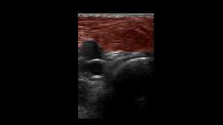 Musculoskeletal Ultrasound Knee 13 Posterior Transverse Scan [upl. by Gabi]