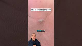 Esto no es un CALLO es VPH medicina Vph shorts [upl. by Farmann320]