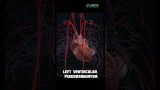 Postinfarction complications  trending shorts humanbiology biology doctor anatomy [upl. by Selestina]