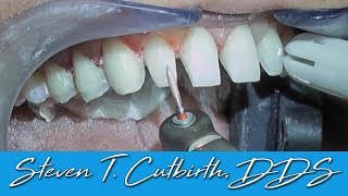 Prepping Teeth for Veneers InDepth Instructions  Dental Minute with Steven T Cutbirth DDS [upl. by Anyrak]