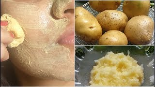 it removed my Dark Spots in 30 Days Potato Facial Mask for Hyper pigmentationSkin WhiteningPimples [upl. by Bette-Ann366]