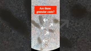 Granular casts vs Amorphous urates medtech medtechstudent urinalysis educationalvideo short [upl. by Burdelle]