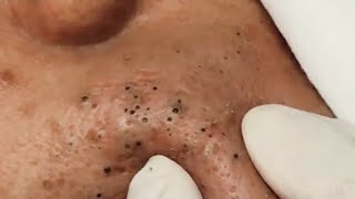 Satisfying Blackhead Removal [upl. by Yemarej]