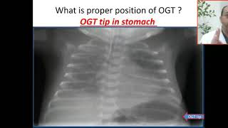 Case 39 orogastric tube insertion normal position OGT tip in stomach [upl. by Elrem]